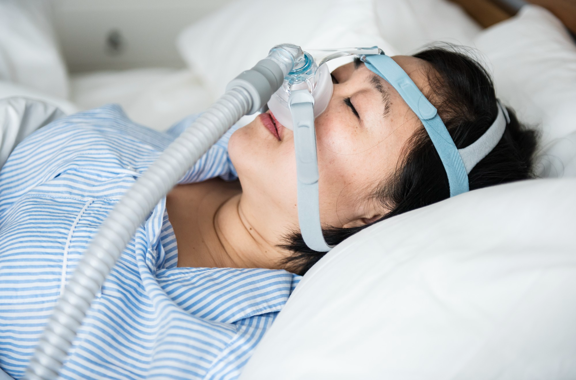 sleep apnea surgery